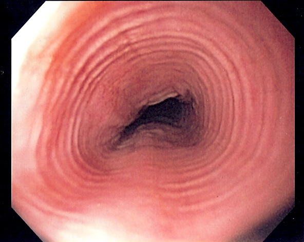 Eosinophilic esophagitis