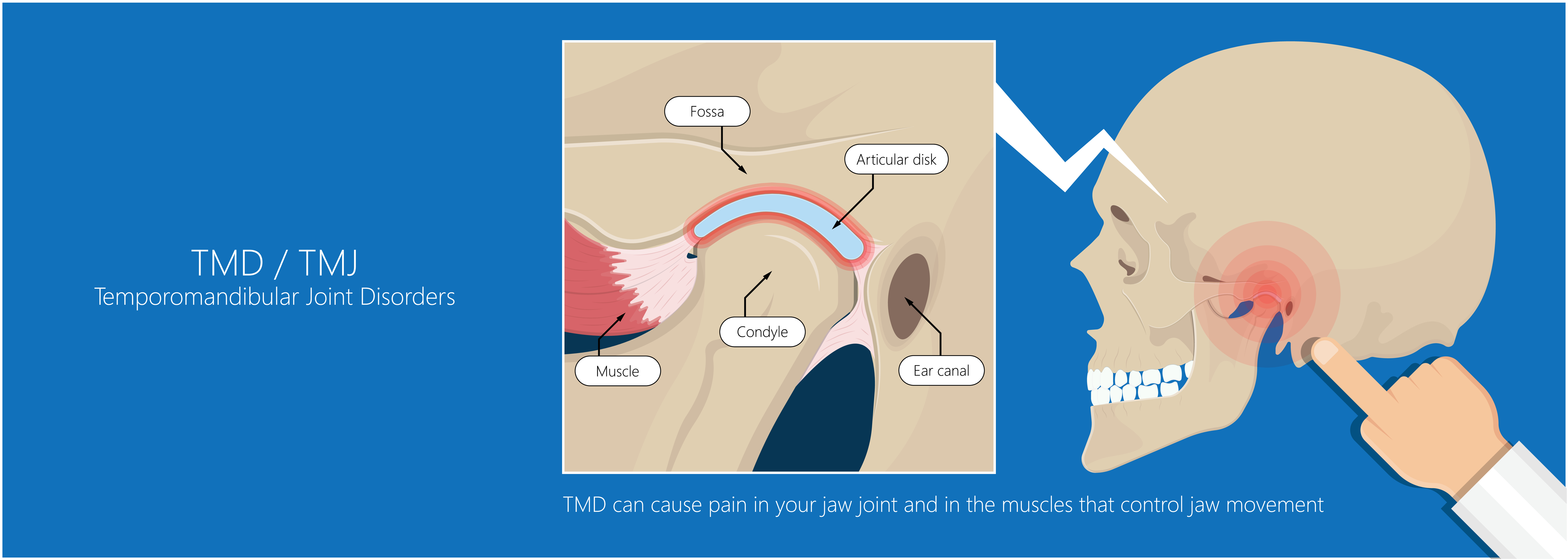 <p>Temporomandibular Joint Disorder