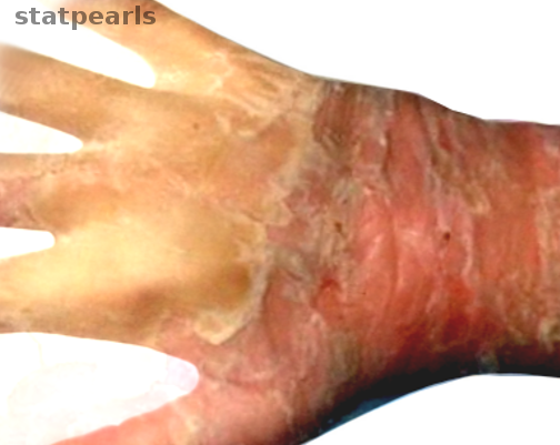 Epidermolytic hyperkeratosis