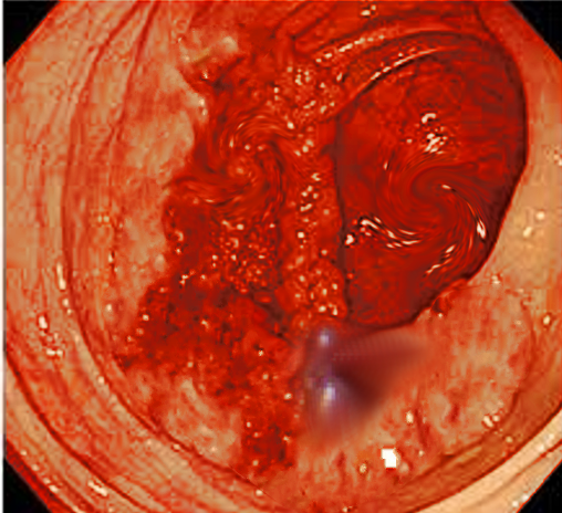 Rectal trauma (gunshot)