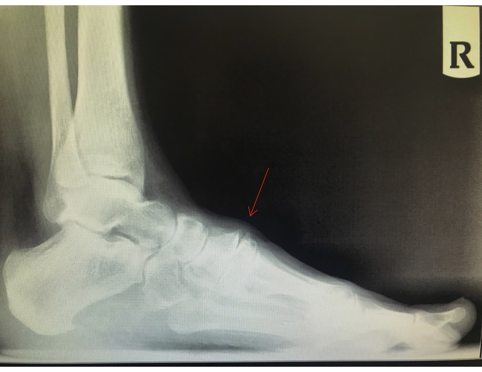 Anterior Tarsal Tunnel Syndrome- Note the dorsal soft tissue swelling and dorsal osteophyte from the metatarsal-cuneiform joint causing distal paresthesias due to medical dorsal cutaneous nerve entrapment