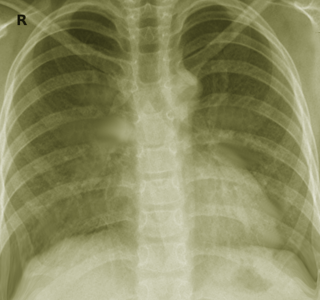 MAI pneumonia