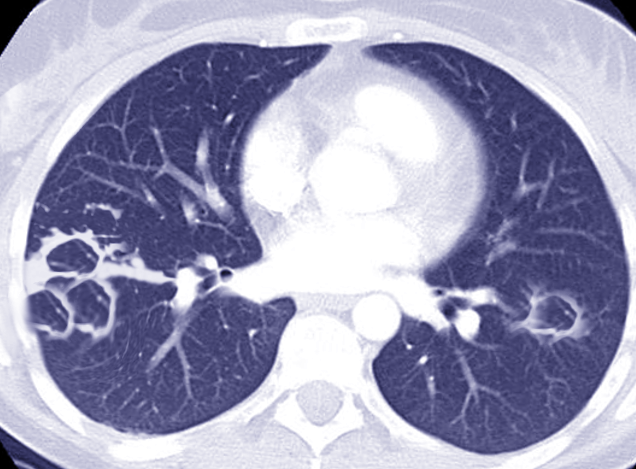 CT Mycobacterium abscessus