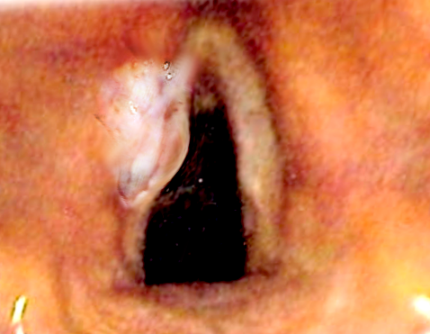 <p>Laryngeal Cancer</p>