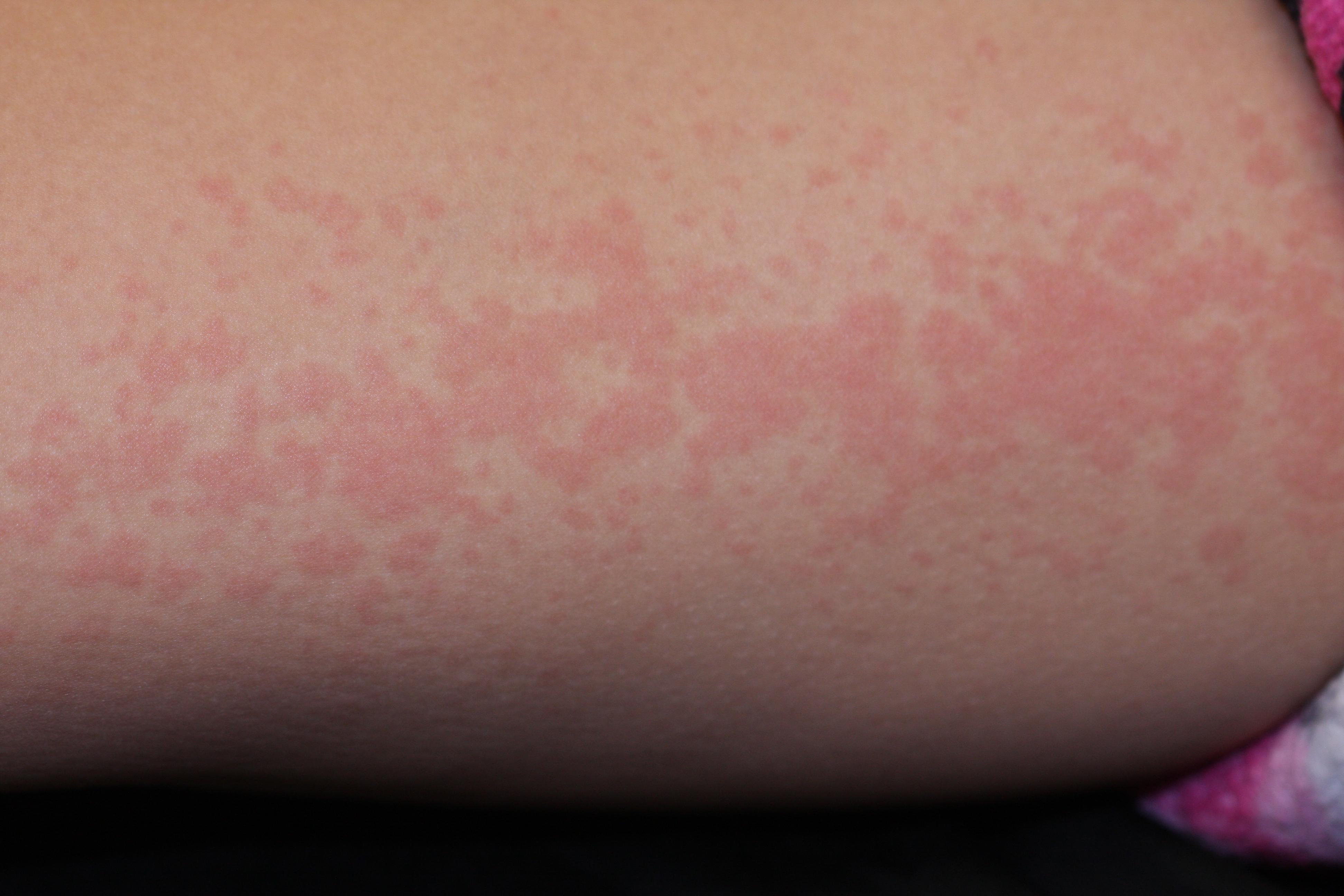 Systemic-onset juvenile idiopathic arthritis with distinct salmon-colored, maculopapular rash