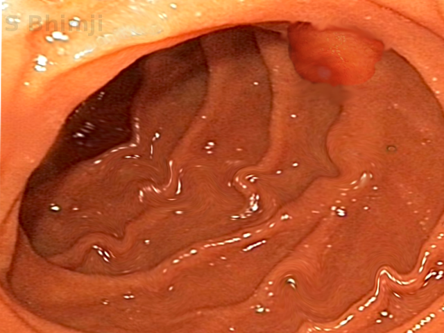 Sphincter of oddi-endoscopy