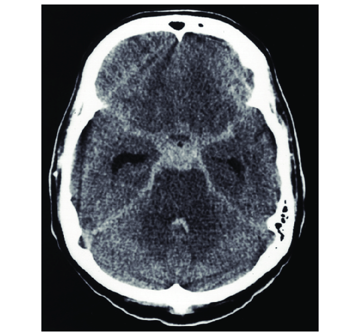 <p>STAR Sign Subarachnoid Hemorrhage</p>