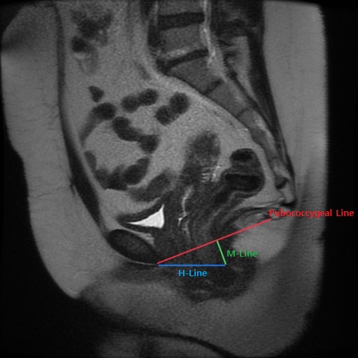 Pelvic Prolapse