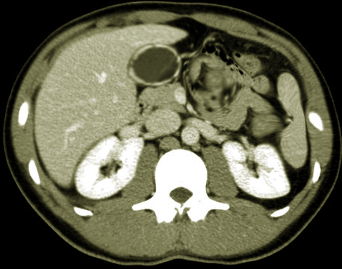 Porcelain gallbladder