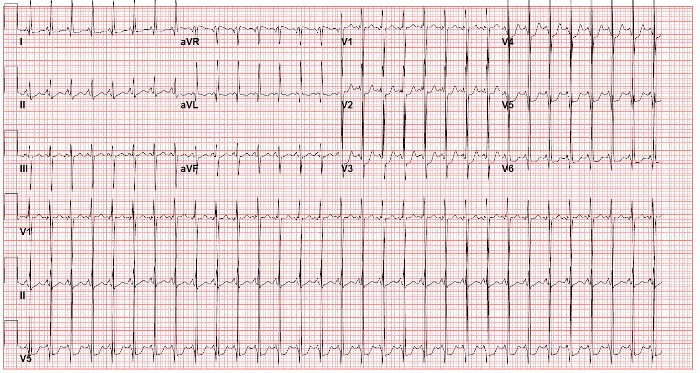 <p>ECG&nbsp;of a Patient With Tricuspid Atresia