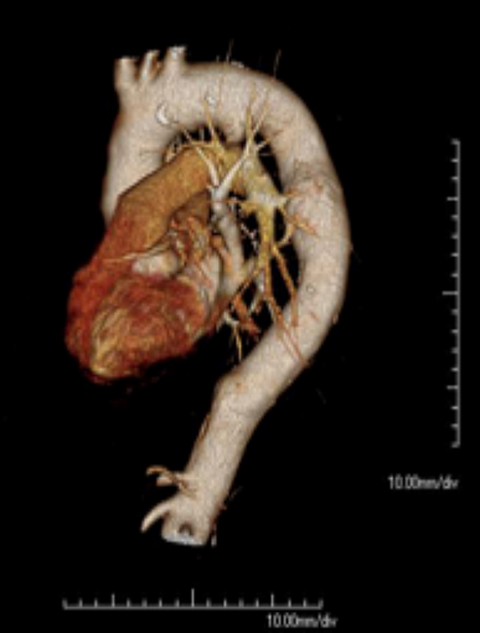 <p>Thoracic Aorta and the Aortic Arch, Computed Tomography Angiography