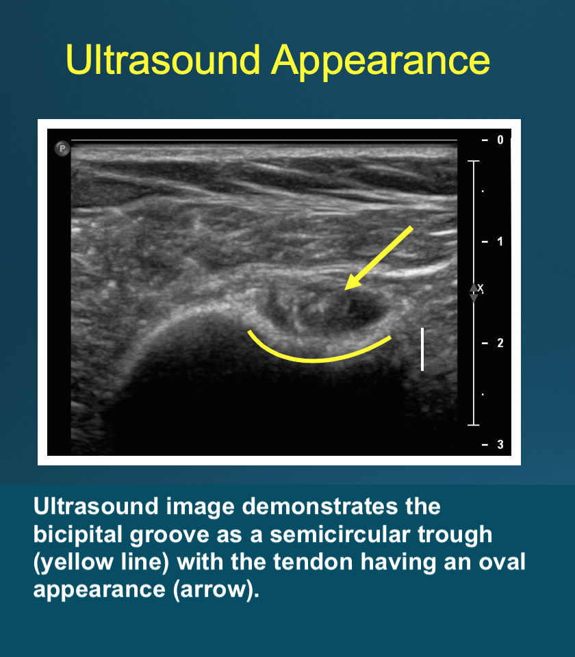 <p>Ultrasound Appearance.</p>