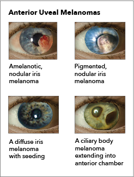 Ocular Melanomas