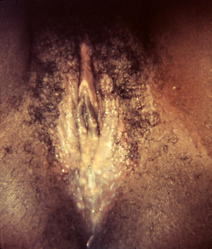 <p>This photograph depicted a close view of a patient&rsquo;s vulva, revealing evidence of an outbreak of herpes genitalis, which had manifested as a pustular-vesicular rash around the vaginal introitus due to the herpes simplex virus type-2 (HSV-2) virus