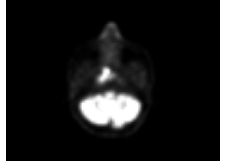 PET- Scan of a patient showing  A hyper-metabolic soft tissue lesion measuring 13 x 10 mm is seen in right nasopharynx