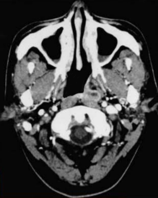 A CT image of a patient with a Left sided nasopharyngeal mass involving the posterior pharyngeal wall and showing minor opaci