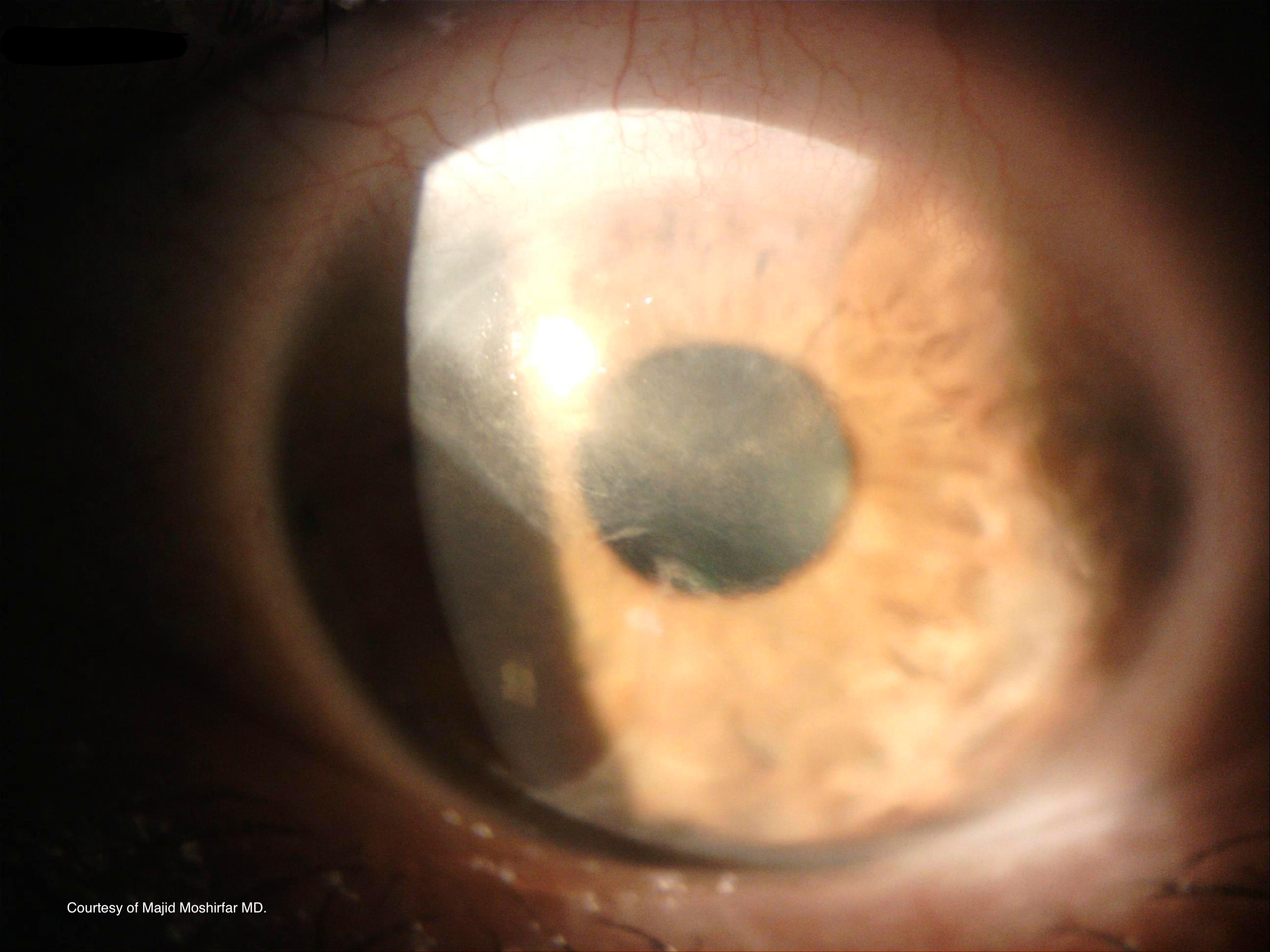 Figure 2. Image of Advancing Wavelike Epitheliopathy