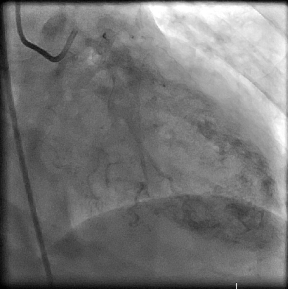 <p>Coronary Cameral Fistula, Left Coronary Artery