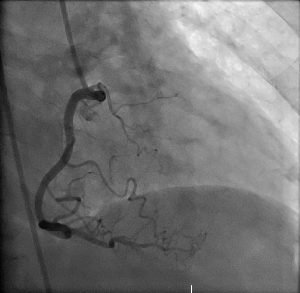 <p>Coronary Cameral Fistula, Right Coronary Artery