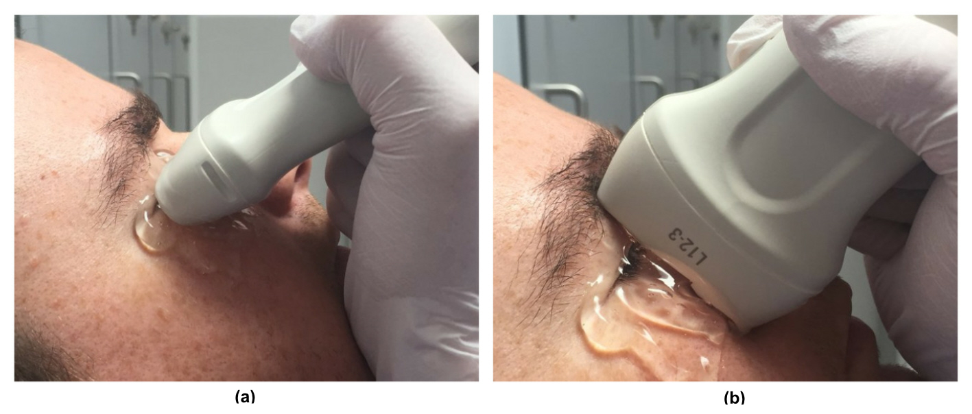 ultrasound in the transverse (a) and parasagittal (b) plane