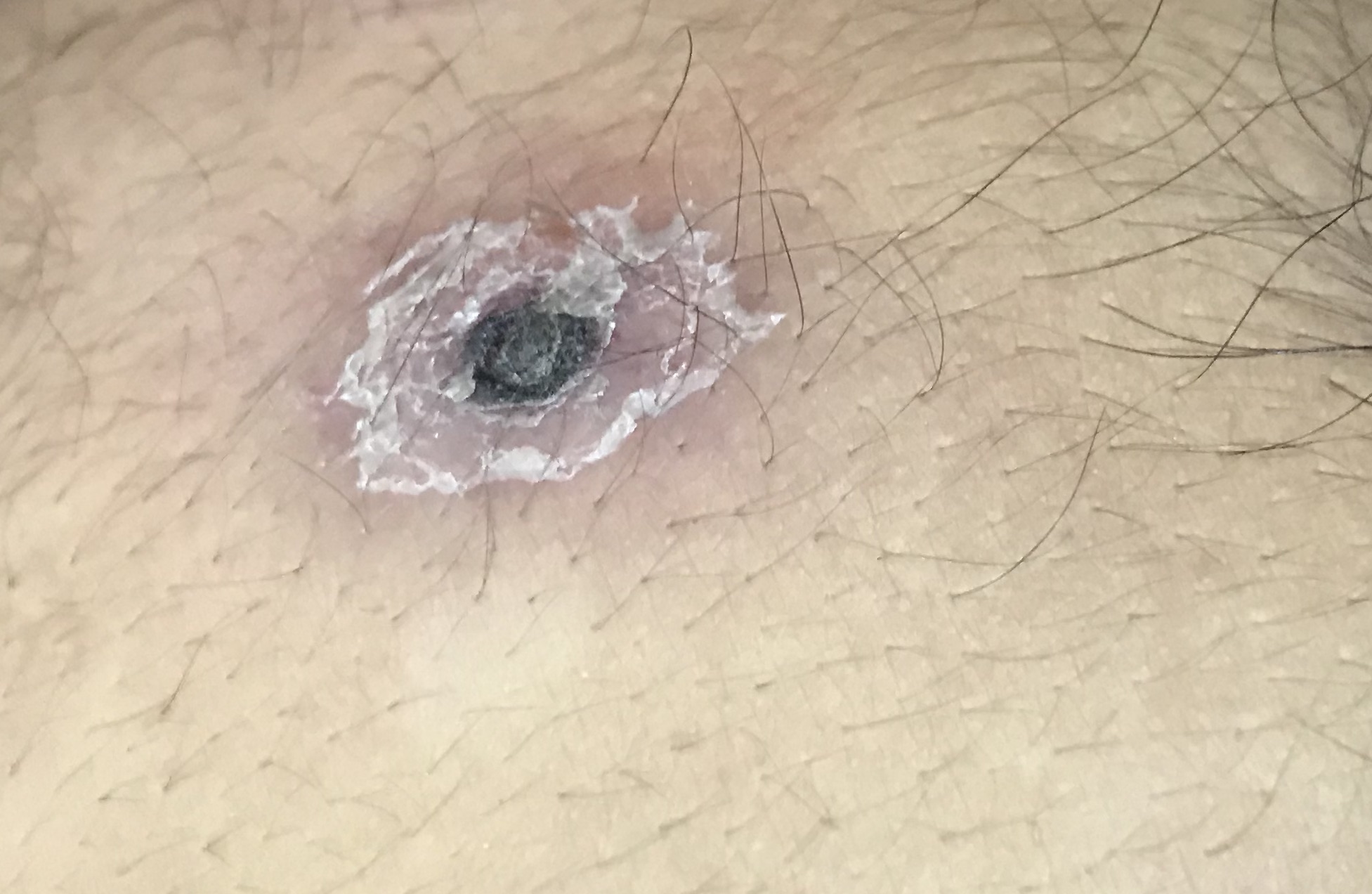 <p>Healing Chigger Bite. Eschar formed on a farmer's chest after a chigger bite.</p>