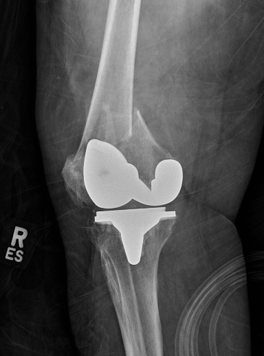 Lateral view of a periprosthetic distal femur fracture about a cemented cruciate retaining total knee arthroplasty