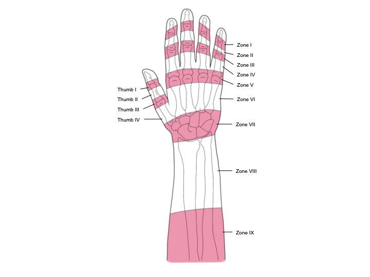 <p>Extensor Tendon Zones in the Hand</p>