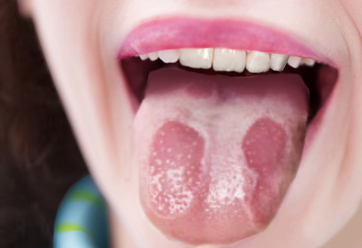 Geographic tongue