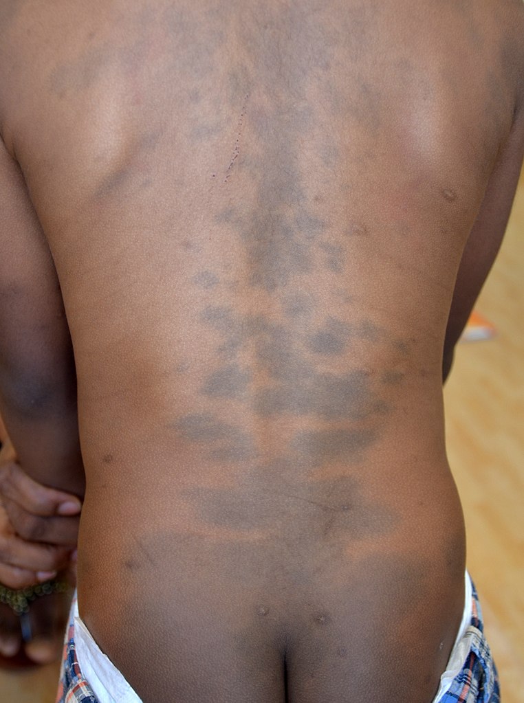 Giant blue nevus (giant mongolian blue spot) on the back and buttocks of an african boy.