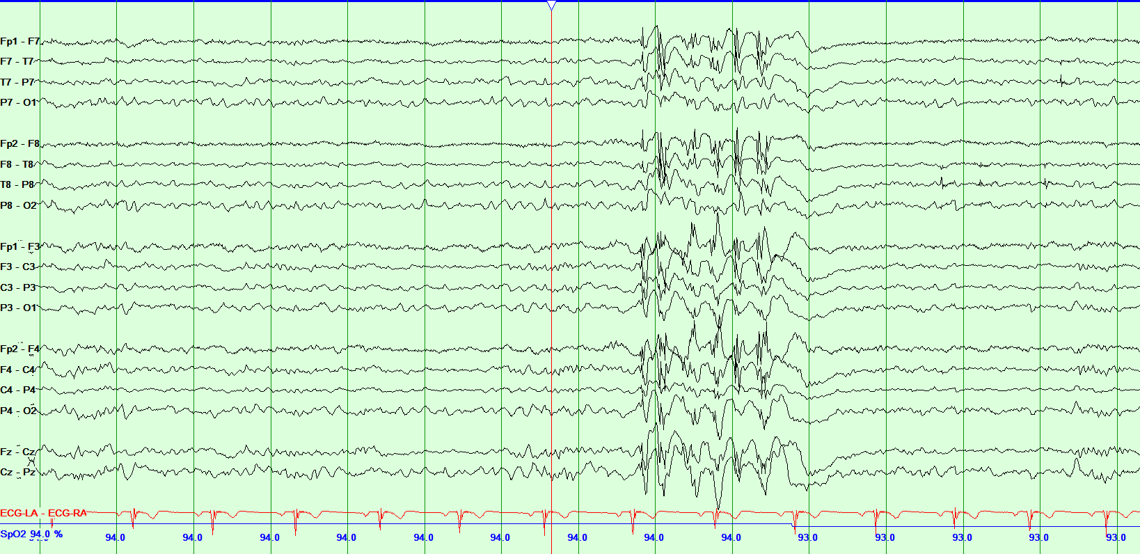 Juvenile Myoclonic Epilepsy