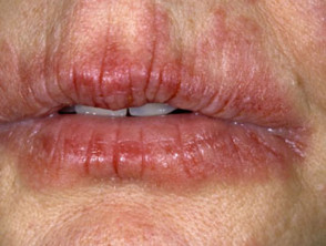 Atopic cheilitis