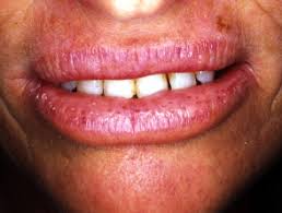 Glandular Cheilitis