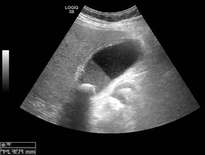 Cholecystitis