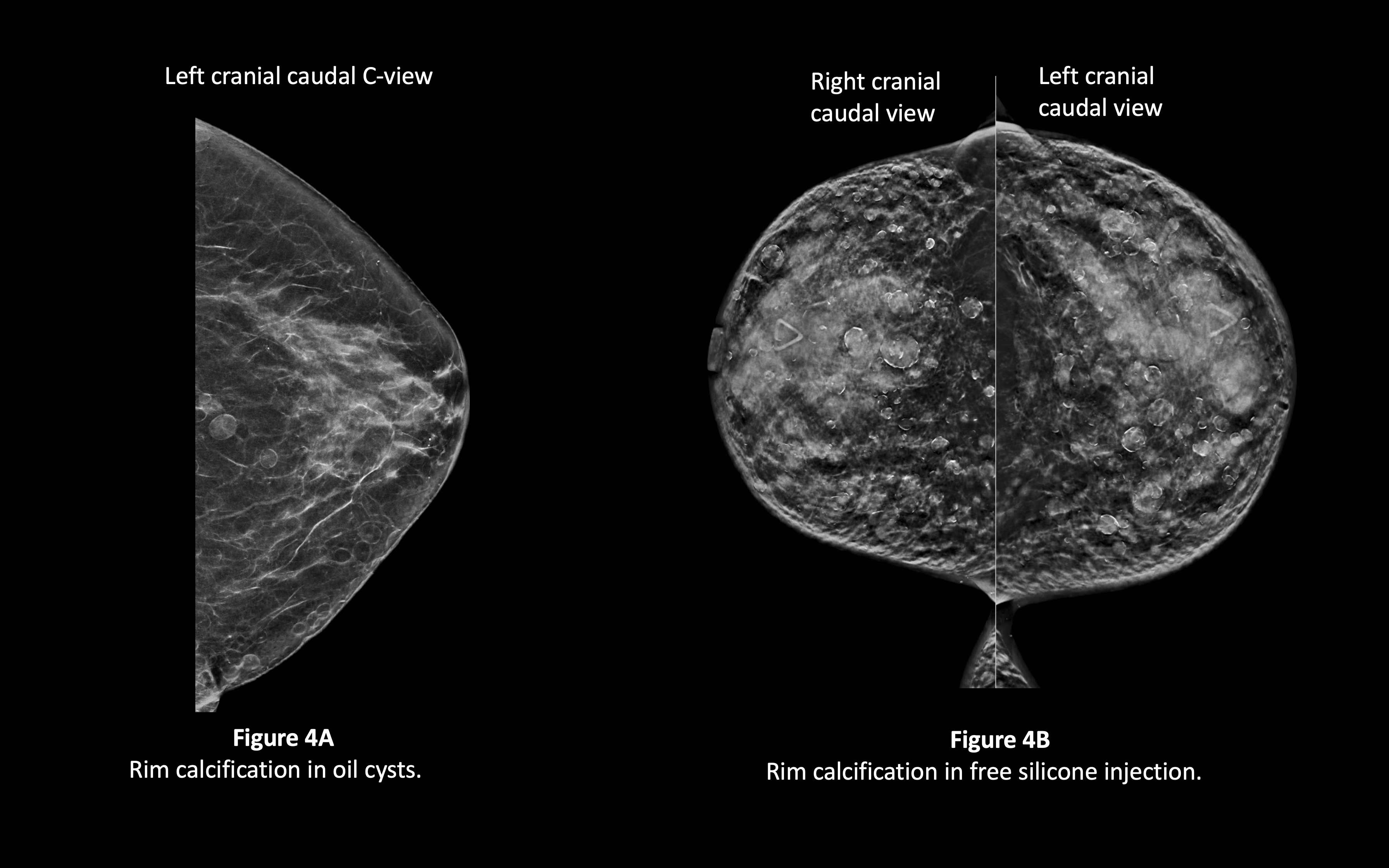 rim calcifications