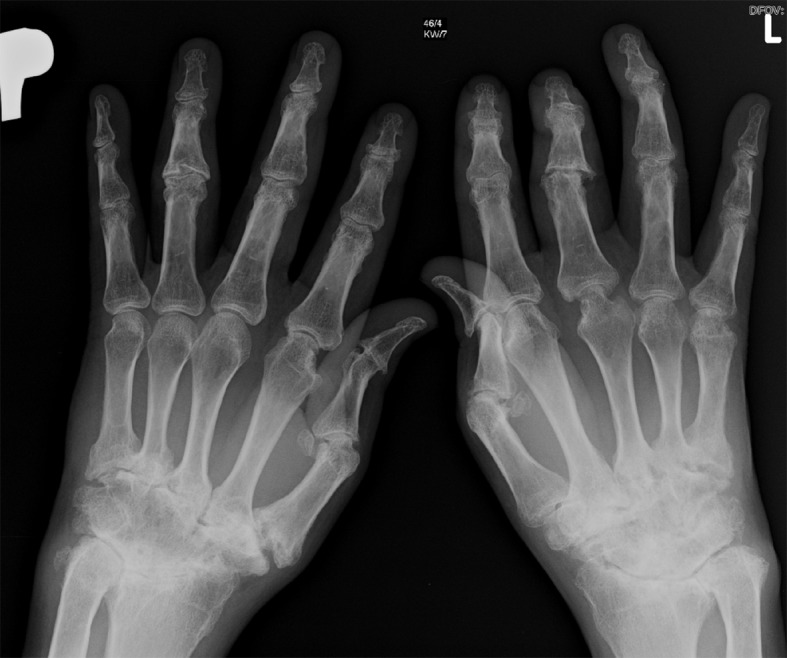 Psoriatic Arthritis: Arthritis Mutilans in patient with Psoriatic Arthrits, showing destruction of both hand joints
