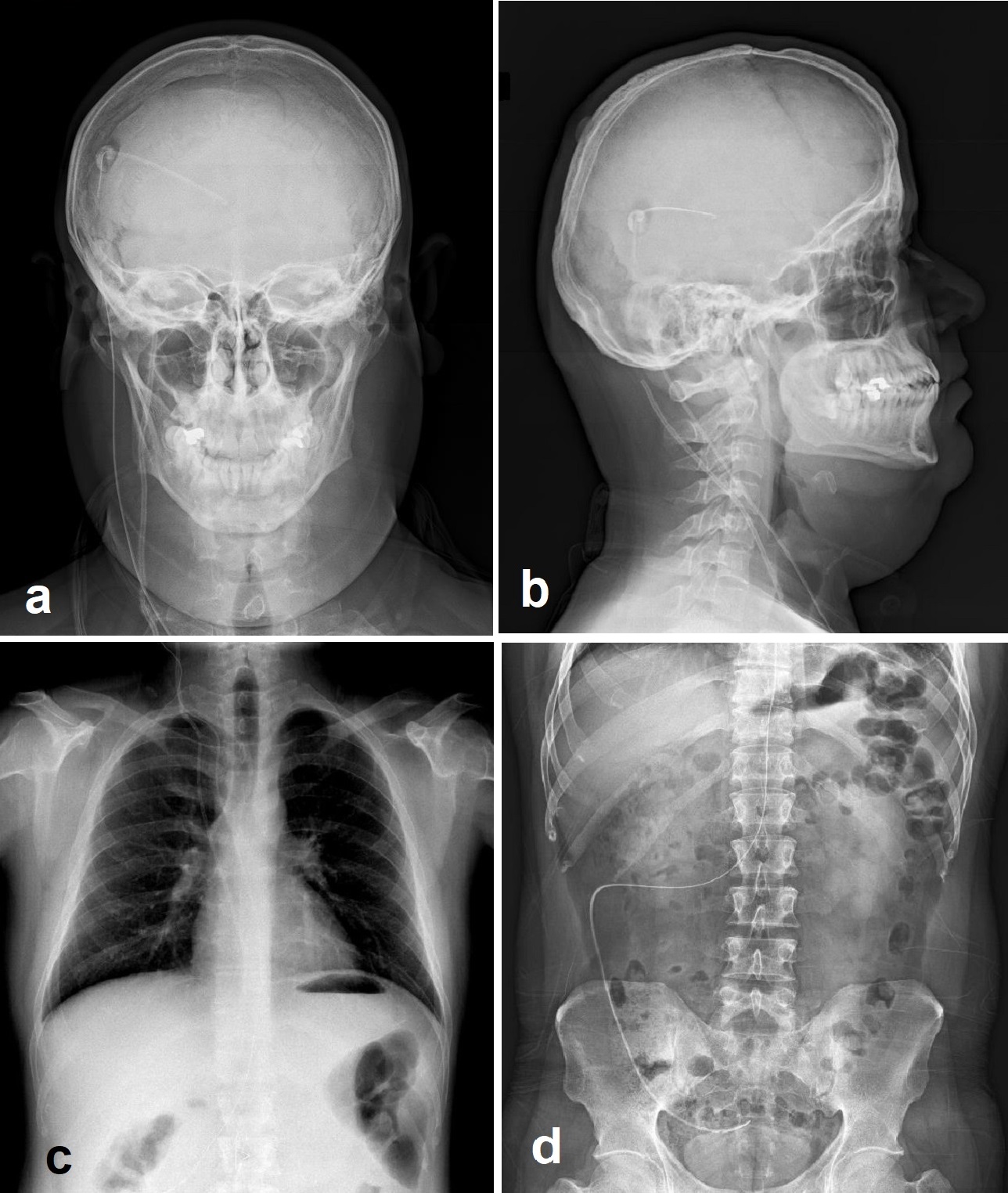 <p>Radiographic Shunt Series