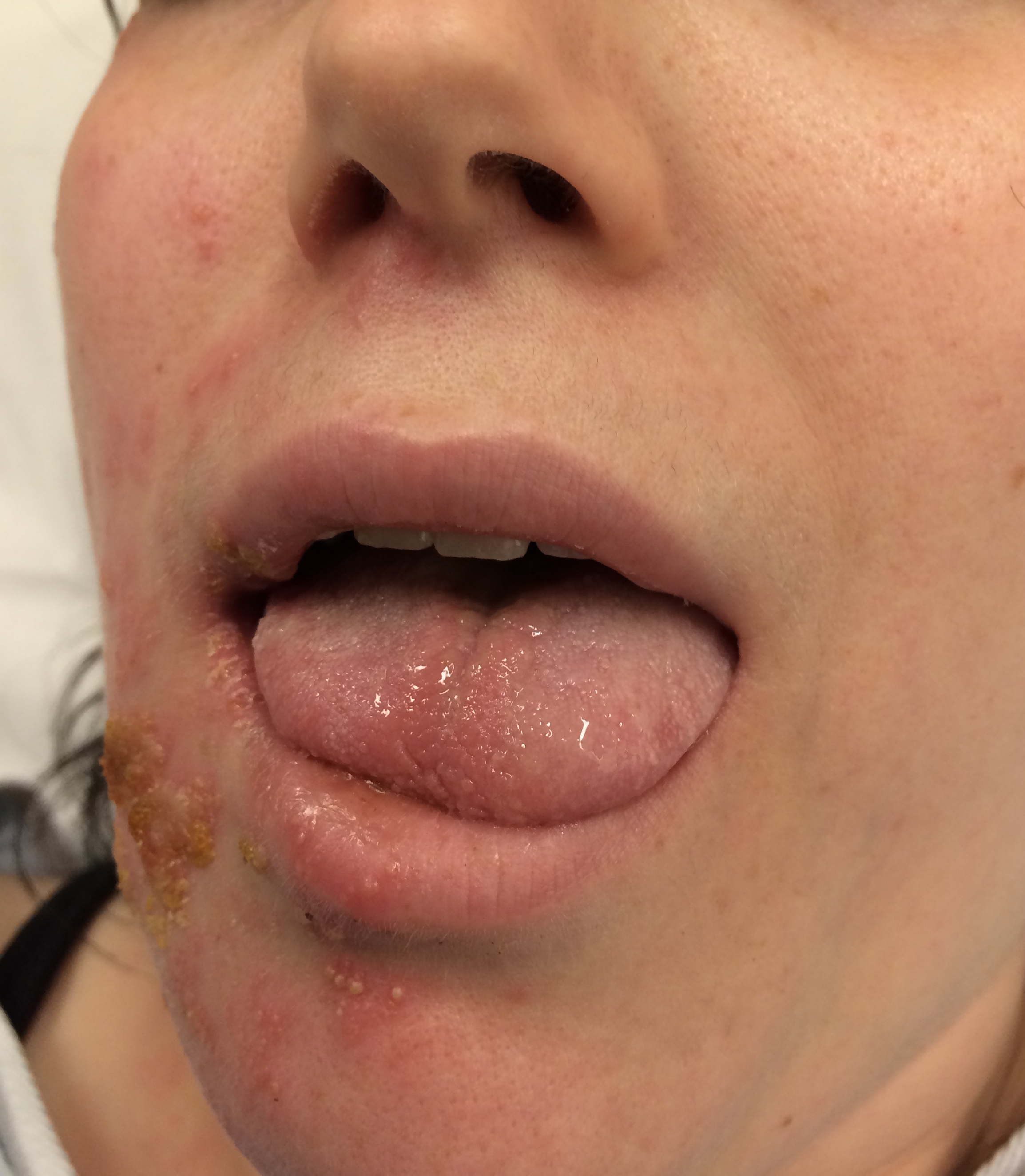 vesicular rash extending to the auricle with facial droop from Ramsay Hunt Syndrome