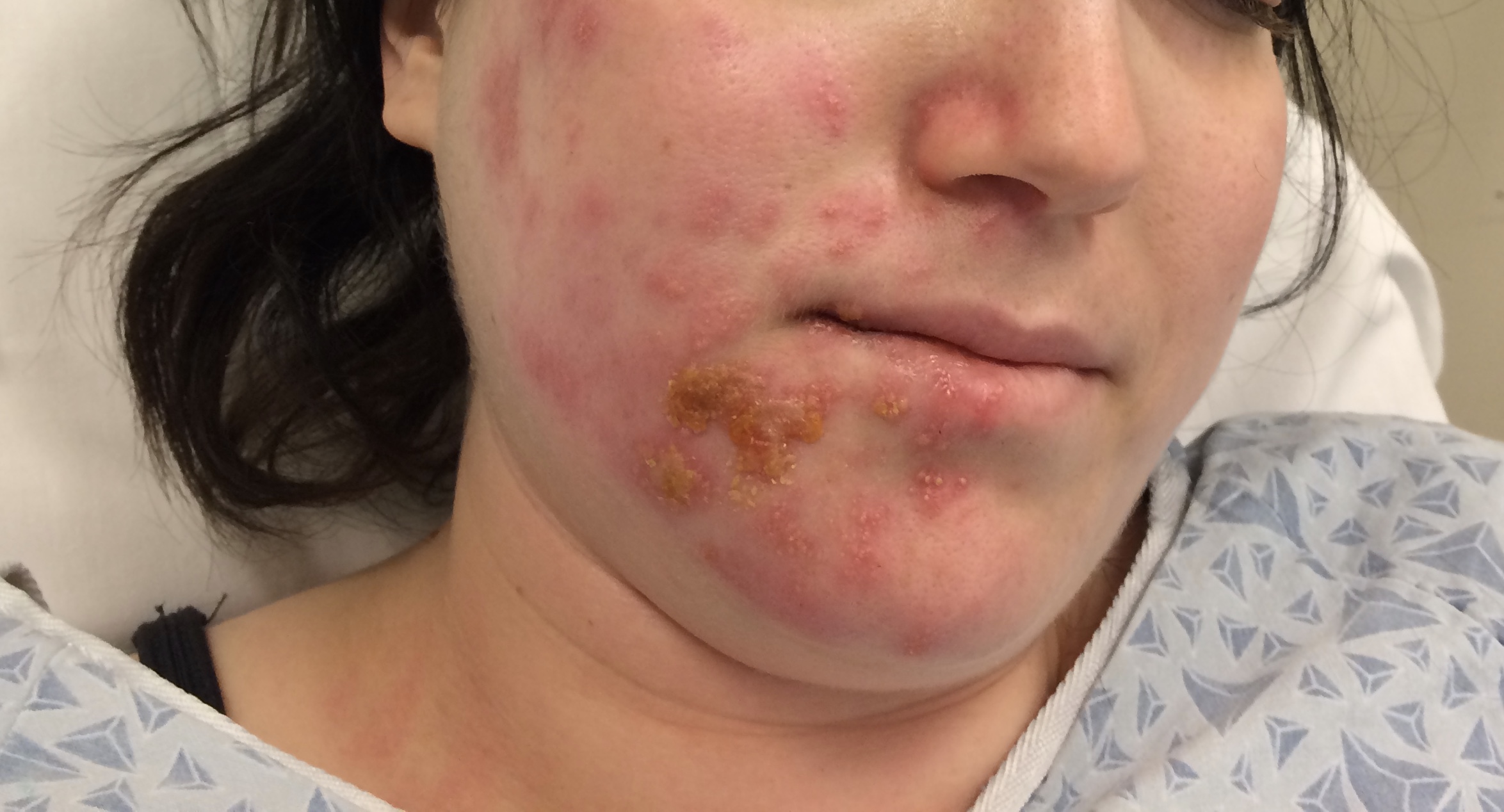 vesicular rash extending to the auricle with facial droop from Ramsay Hunt Syndrome