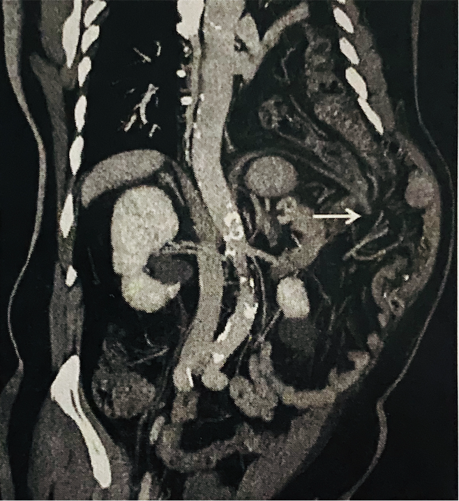 Coronal view of discontinuity of diaphragm sign with loss of integrity on the left with splenic flexure herniation into the left thorax