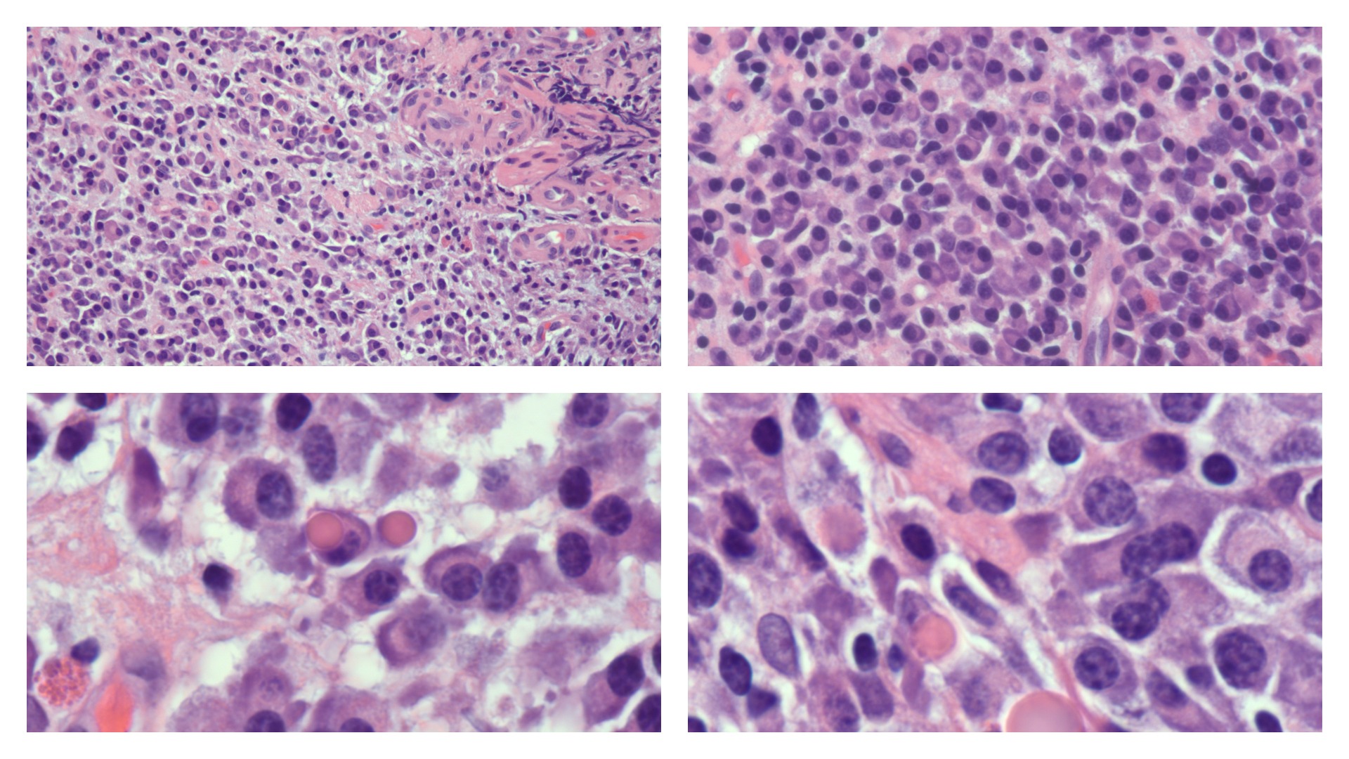 <p>Plasma Cells