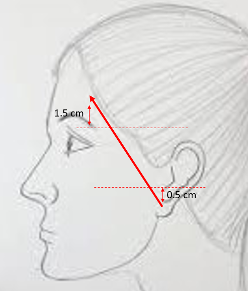 <p>Course of the Temporal Branch