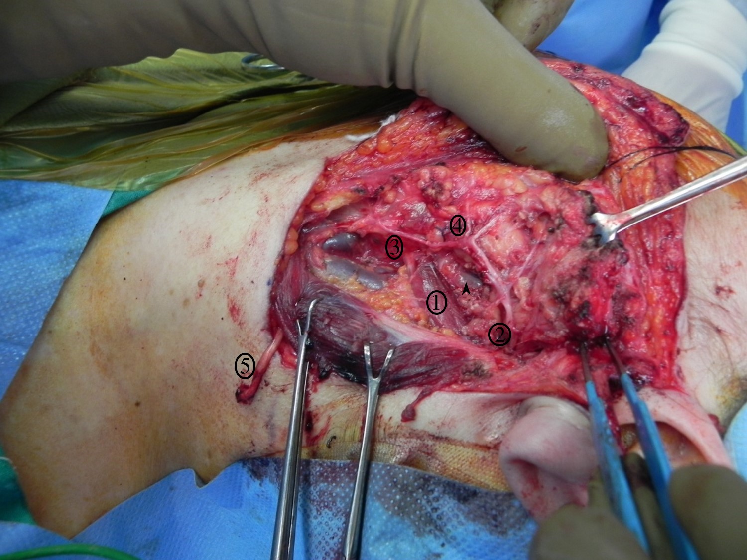 <p>Superficial Parotidectomy for A Benign Salivary Gland Tumor