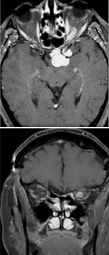 Optic nerve sheath meningioma: "Tram-track" sign seen in the upper axial contrast-enhanced MRI in a patient with optic nerve sheath meningioma