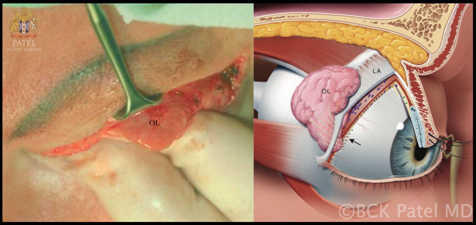 Lacrimal Gland: Peroperative view of the right orbital lobe of the lacrimal gland (OL) and schematic drawing of the right orbital lobe and palpebral lobe of the lacrimal gland divided by the levator aponeurosis (LA)