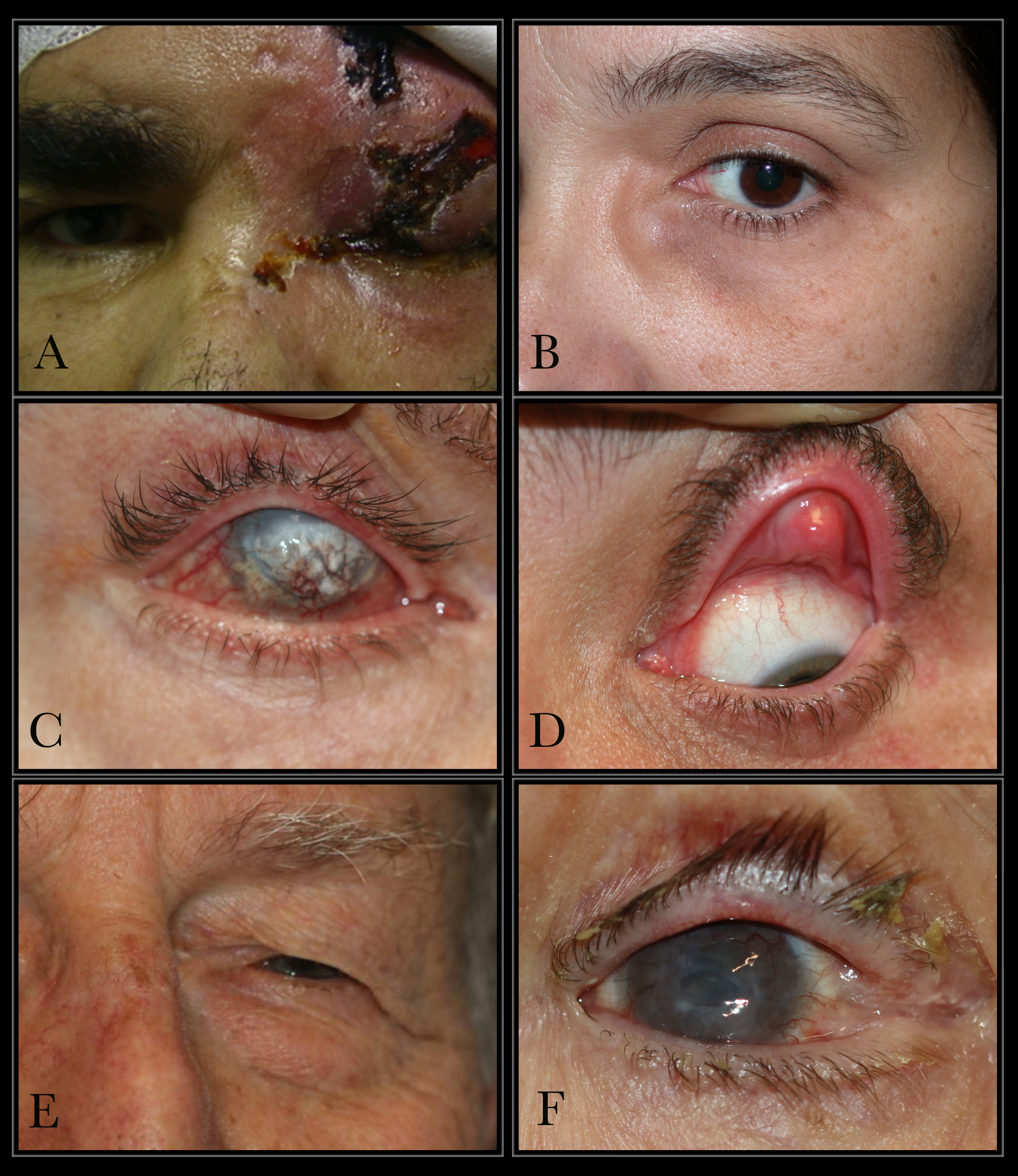 <p>Causes of Epiphora