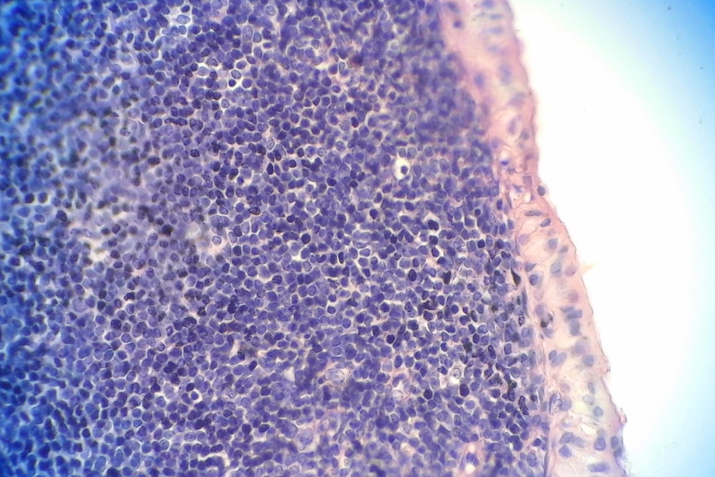 <p>Bilayered Eosinophilic Oncocytic Epithelium Lining the Cyst Lumen