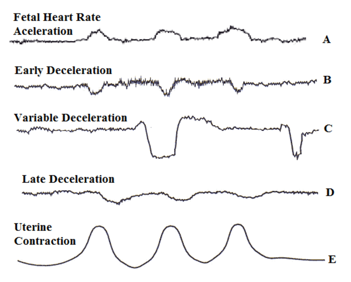 Fetal heart rate changes