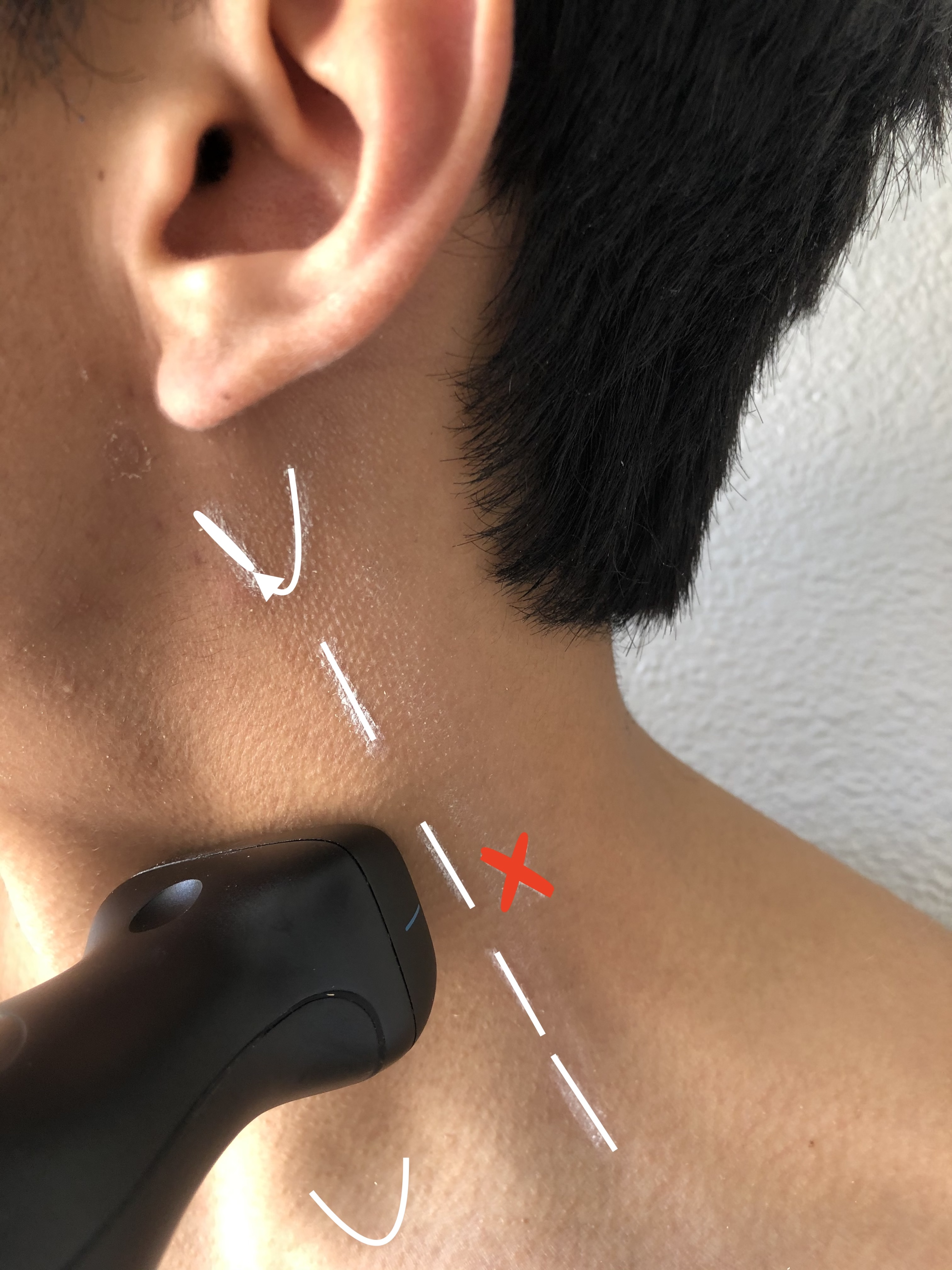 Correct placement of probe at the middle of the posterior border of the sternocleidomastoid muscle for a superficial cervical plexus block