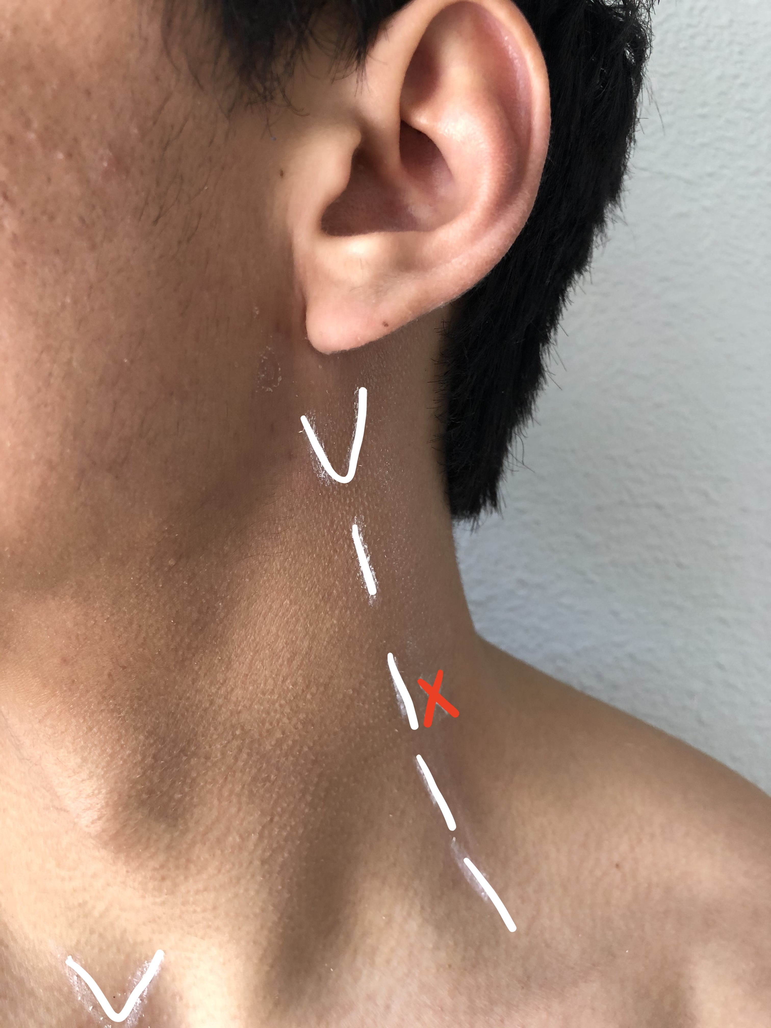 The white "V" inferior to earlobe is over the mastoid process