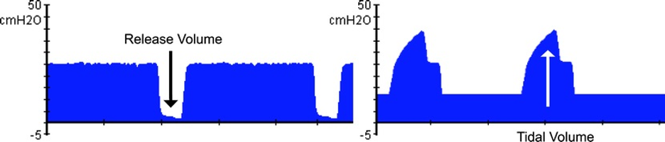 <p>Tidal Volume Comparison During APRV&nbsp;Versus Conventional Ventilation